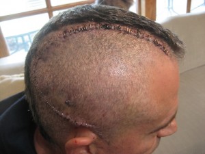 Sutures all